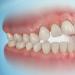 ماذا تعني الفجوة بين الأسنان الأمامية والجانبية وشكلها الحاد وأحجامها الصغيرة أو الكبيرة؟
