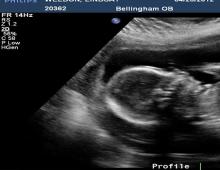 20:e graviditetsveckan: foto, mage, ultraljud, förnimmelser
