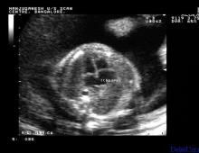First fetal heartbeat on ultrasound