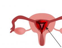 Är det möjligt att bli gravid på egen hand med kronisk endometrit?