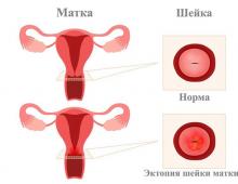 गर्भावस्था के दौरान गर्भाशय ग्रीवा का क्षरण - क्या यह खतरनाक है?