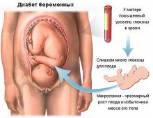 Glukostoleranstest under graviditet, hur man tar det